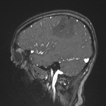 Cerebral venous infarction - hemorrhagic (Radiopaedia 81625-95505 Sagittal MRV 22).jpg