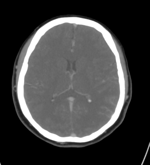 Cerebral venous infarction due to transverse sinus thrombosis (Radiopaedia 34688-36120 Axial CT venogram 29).png