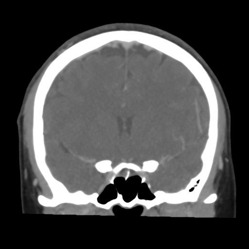 File:Cerebral venous infarction due to transverse sinus thrombosis (Radiopaedia 34688-36120 Coronal 27).png