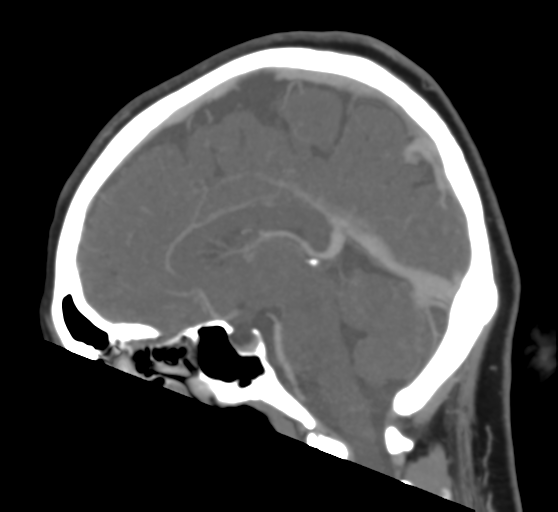 Cerebral venous infarction due to transverse sinus thrombosis (Radiopaedia 34688-36120 Sagittal CT venogram 29).png