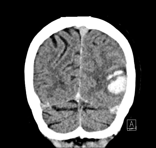Cerebral venous infarction with hemorrhage (Radiopaedia 65343-74381 Coronal non-contrast 47).jpg