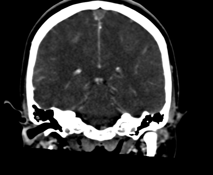 Cerebral venous sinus thrombosis (Radiopaedia 59224-66646 Coronal C+ delayed 46).jpg
