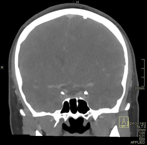 File:Cerebral venous sinus thrombosis (Radiopaedia 91329-108965 Coronal venogram 38).jpg