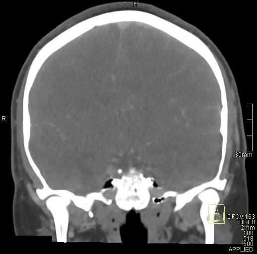 Cerebral venous sinus thrombosis (Radiopaedia 91329-108965 Coronal venogram 44).jpg