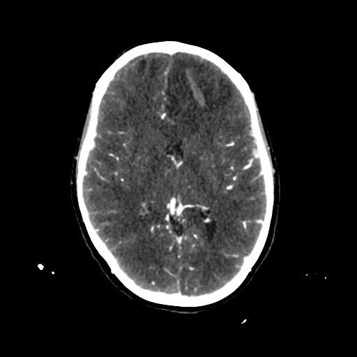 File:Cerebral venous throbmosis - hemorrhagic venous infarction (Radiopaedia 87318-103613 Axial CT venogram 17).jpg