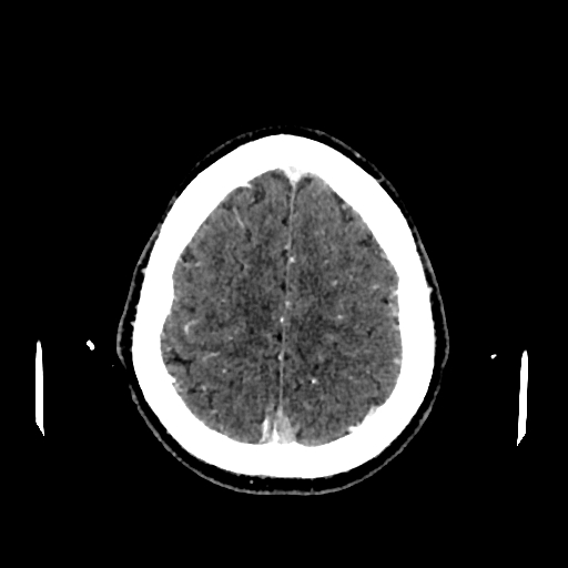 File:Cerebral venous thrombosis (CVT) (Radiopaedia 77524-89685 Axial with contrast 31).jpg
