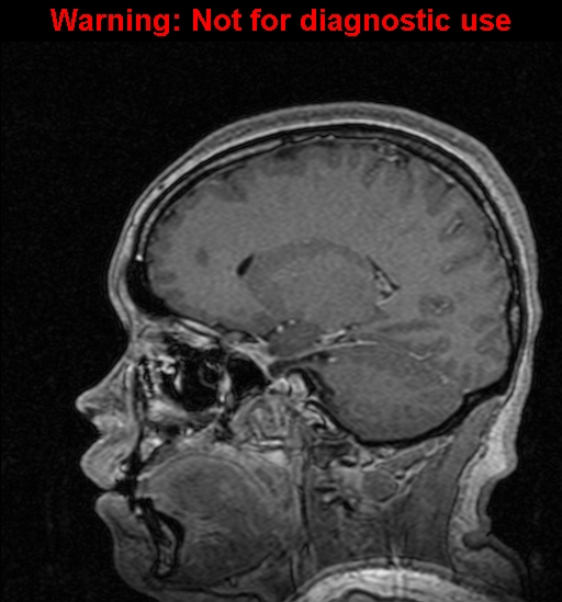 Cerebral venous thrombosis (Radiopaedia 37224-39208 Sagittal T1 C+ 60).jpg
