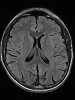 File:Cerebral venous thrombosis (Radiopaedia 38392-40469 Axial FLAIR 14).png
