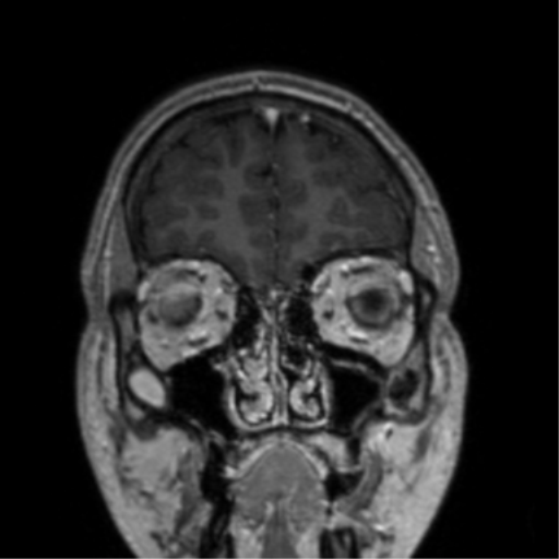 Cerebral venous thrombosis (Radiopaedia 38392-40469 Coronal T1 C+ 76).png