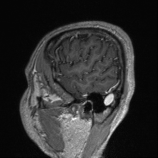 File:Cerebral venous thrombosis (Radiopaedia 38392-40469 Sagittal T1 C+ 76).png