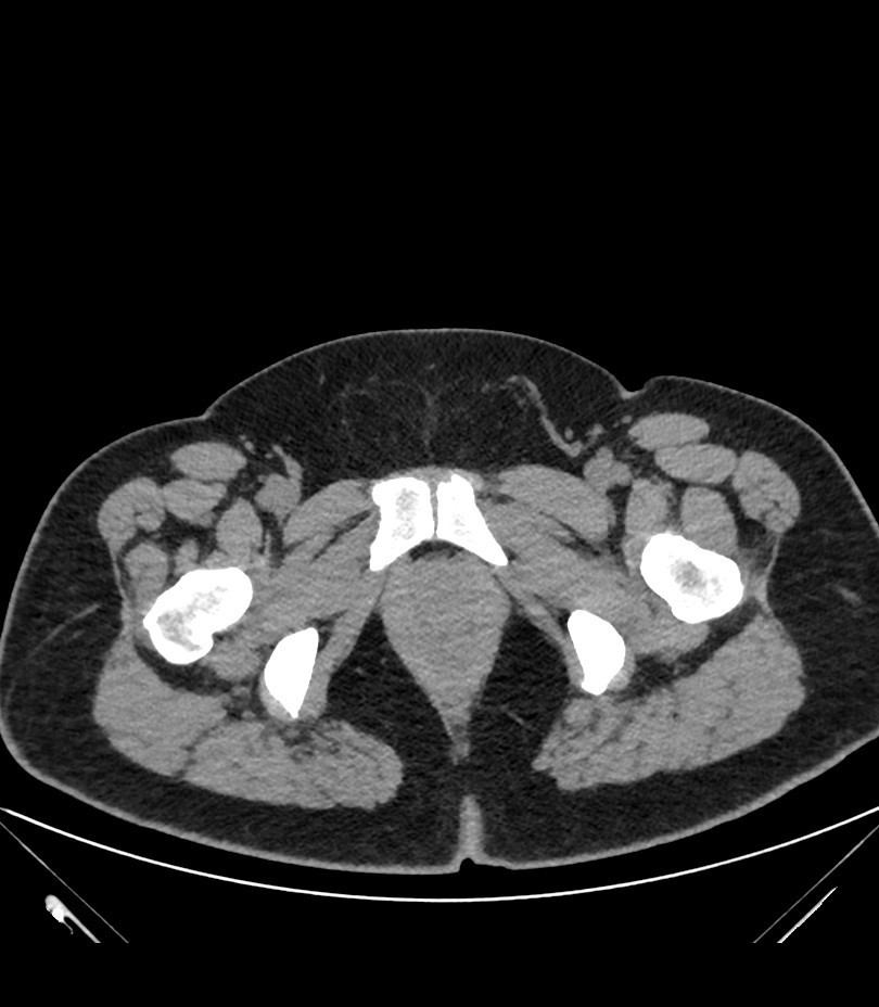 Cervical aortic arch with coarctation and aneurysms (Radiopaedia 44035-47552 Axial non-contrast 100).jpg