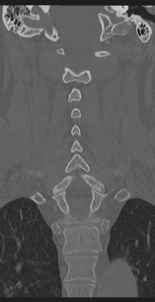 Cervical canal stenosis due to ossification of the posterior longitudinal ligament (Radiopaedia 47260-51823 Coronal bone window 37).png