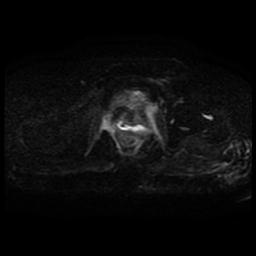 File:Cervical carcinoma (Radiopaedia 70924-81132 Axial DWI 33).jpg