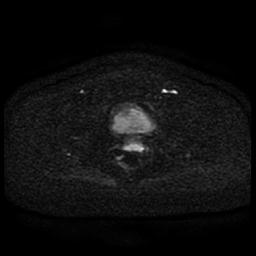 File:Cervical carcinoma (Radiopaedia 85405-101028 Axial DWI 46).jpg