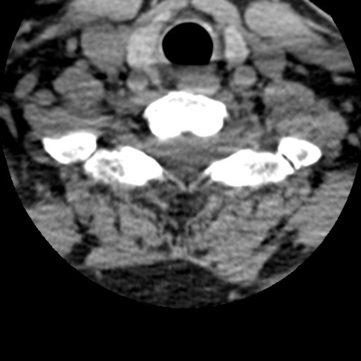 File:Cervical spinal neurofibroma in a patient with NF1 (Radiopaedia 58344-65464 Axial non-contrast 63).jpg