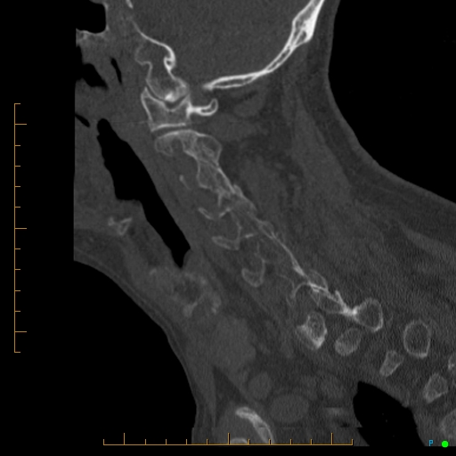 File:Cervical spine fracture - ankylosing spondylitis (Radiopaedia 76835-88706 Sagittal bone window 77).jpg