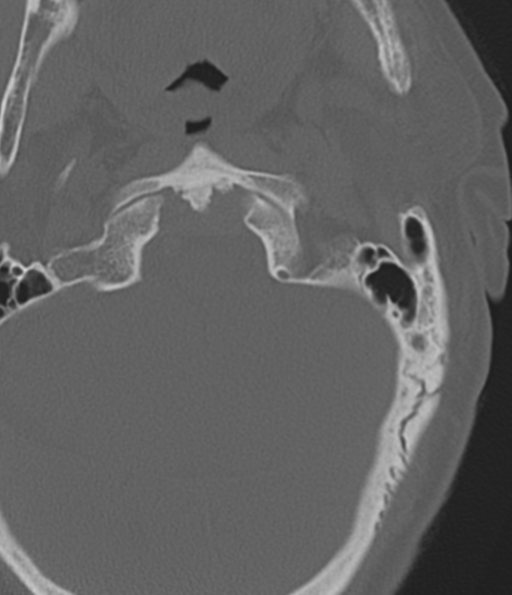 Cervical spine fracture in the setting of ankylosis (Radiopaedia 37038-38715 Axial bone window 10).png