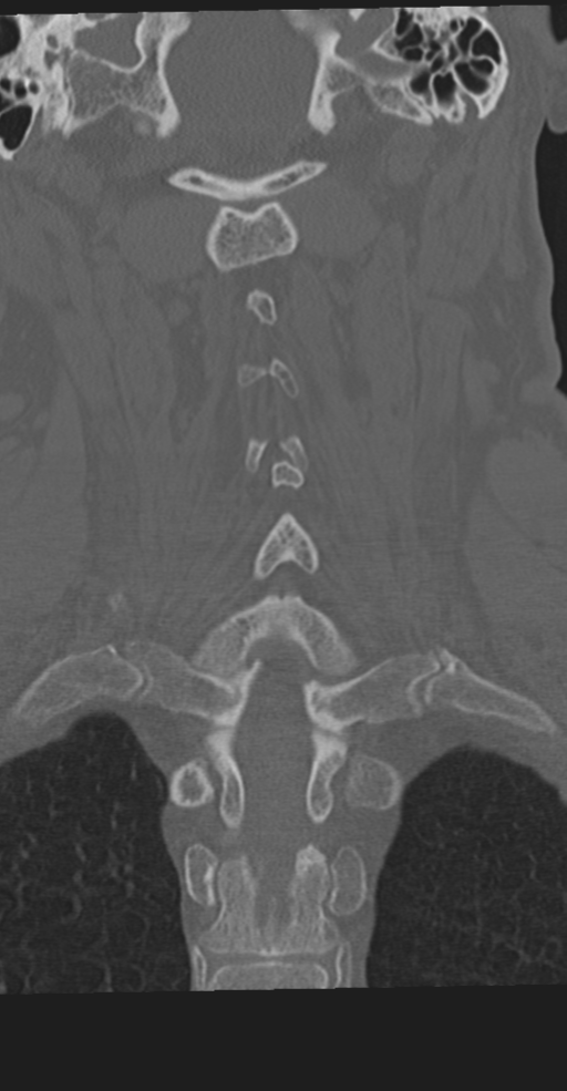 Cervical spine fracture in the setting of ankylosis (Radiopaedia 37038-38715 Coronal bone window 47).png