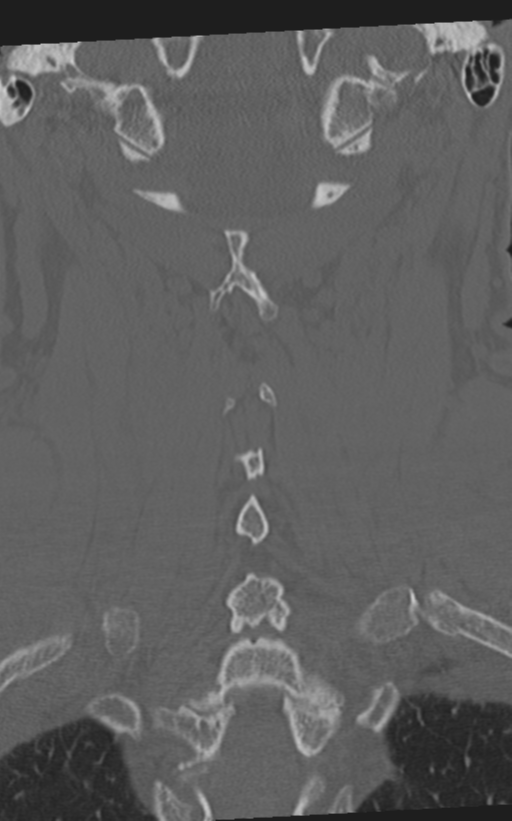 Cervical spine fractures with vertebral artery dissection (Radiopaedia 53296-59268 Coronal bone window 50).png