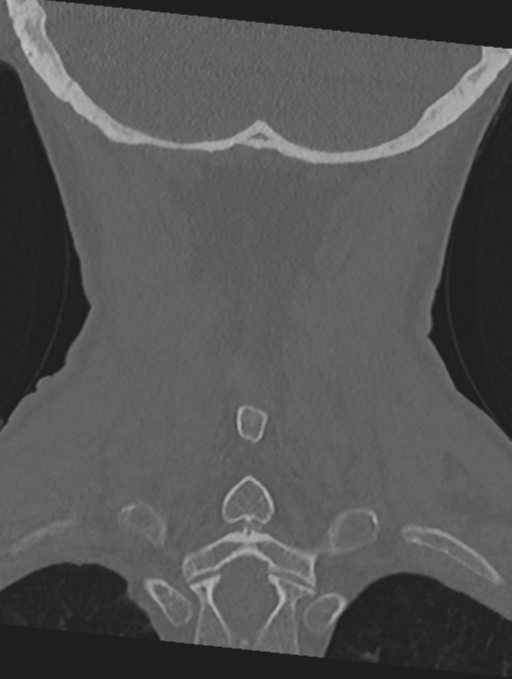 Cervical spondylolysis (Radiopaedia 49616-54811 Coronal bone window 48).png