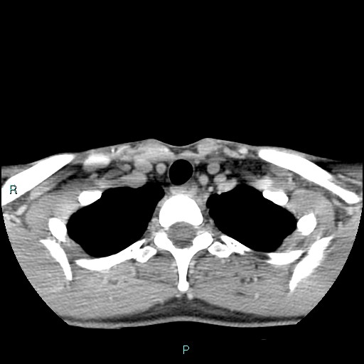 Cervical thymic cyst (Radiopaedia 88632-105335 C 29).jpg