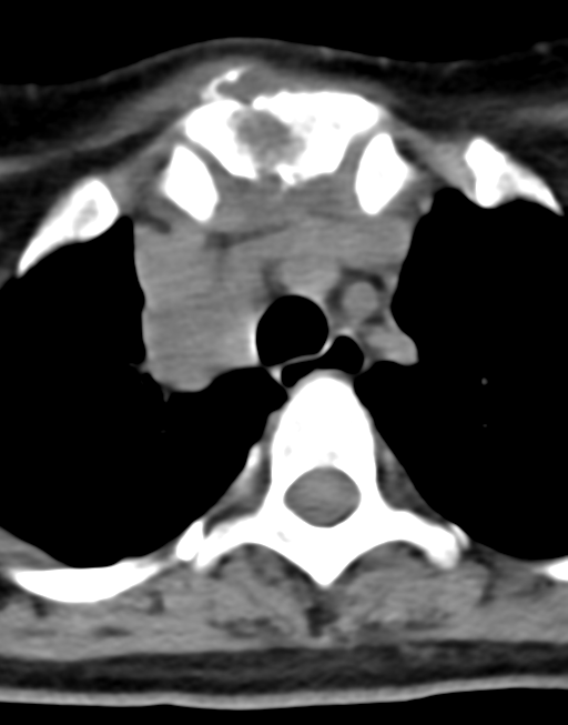 Cervical tuberculous spondylitis (Radiopaedia 39149-41365 Axial non-contrast 56).png