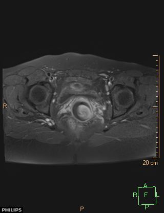File:Cesarian scar endometriosis (Radiopaedia 68495-78066 Axial T1 C+ fat sat 18).jpg
