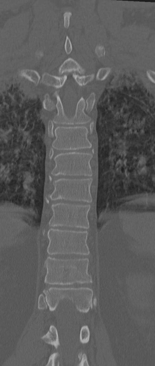 Chance fracture (Radiopaedia 33854-35020 Coronal bone window 56).png