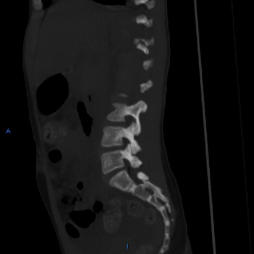 File:Chance fracture with duodenal and pancreatic lacerations (Radiopaedia 43477-50042 Sagittal bone window 18).jpg