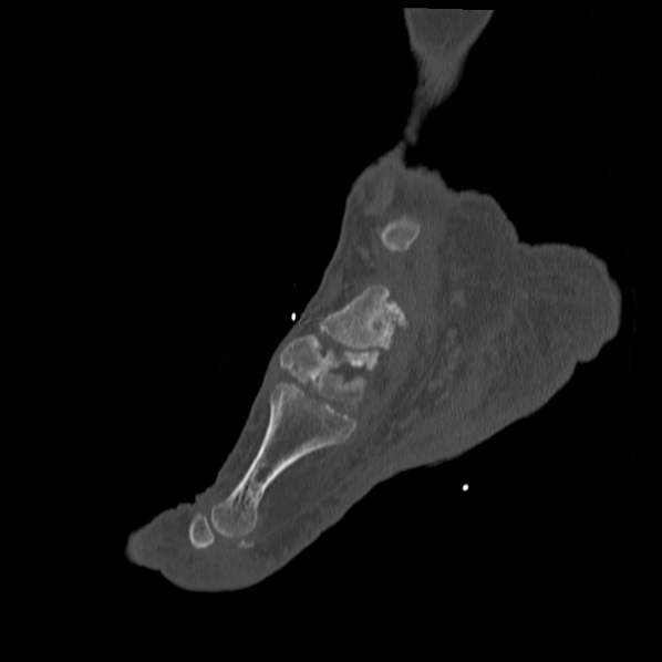 Charcot joint (Radiopaedia 36629-38194 Sagittal bone window 67).jpg