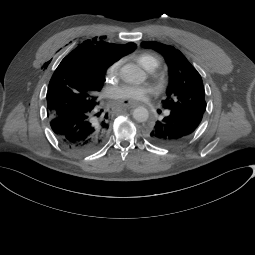 File:Chest multitrauma - aortic injury (Radiopaedia 34708-36147 A 158).png