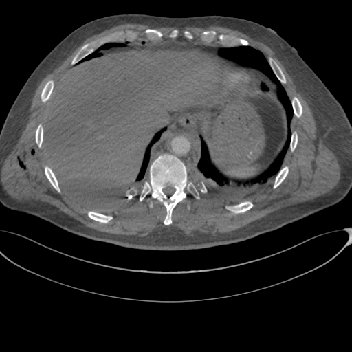 File:Chest multitrauma - aortic injury (Radiopaedia 34708-36147 A 248).png