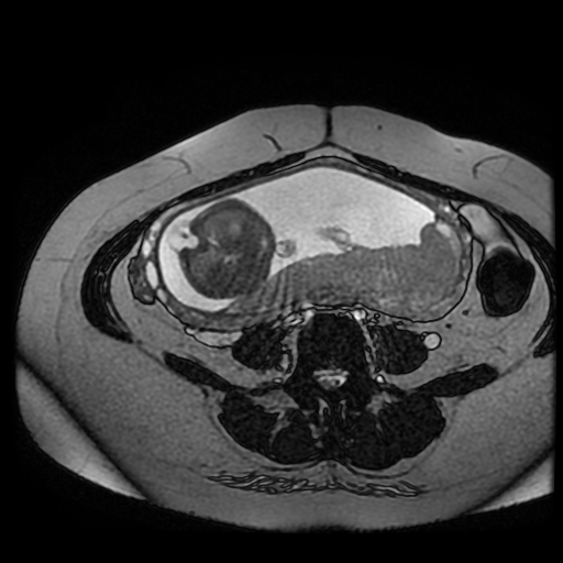 Chiari II malformation - fetal MRI (Radiopaedia 68099-77581 Axial Fiesta 19).jpg