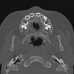Choanal atresia (Radiopaedia 88525-105975 Axial bone window 7).jpg