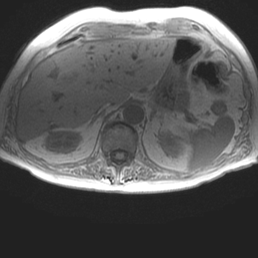 File:Cholangiocarcinoma - mass-forming pattern (Radiopaedia 16017-15677 T1 in-phase 10).jpg