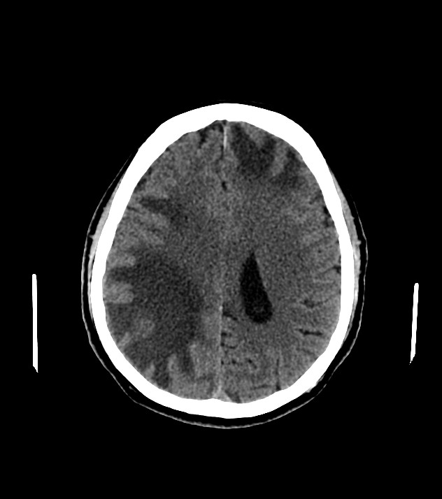 Cholangiocarcinoma with cerebral metastases (Radiopaedia 83519-98628 Axial non-contrast 44).jpg