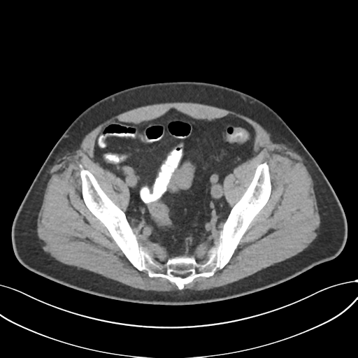 File:Cholecystitis with focal perforation and hepatic abscess (Radiopaedia 37189-38945 Axial non-contrast 71).png