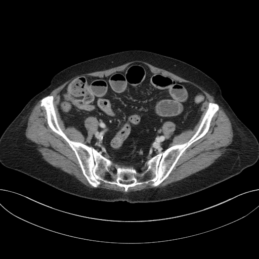 Cholecystoduodenal fistula due to calculous cholecystitis with gallstone migration (Radiopaedia 86875-103077 D 61).jpg