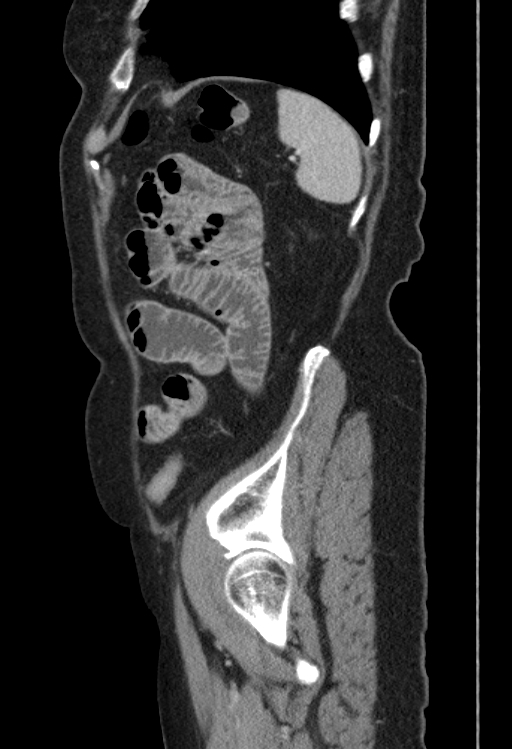 Cholecystoduodenal fistula due to calculous cholecystitis with gallstone migration (Radiopaedia 86875-103077 F 9).jpg