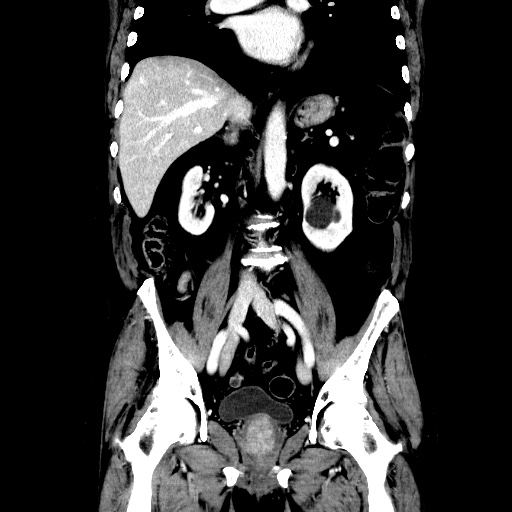 Choledocholiathiasis with normal caliber common bile duct (Radiopaedia 75368-86632 Coronal liver window 73).jpg