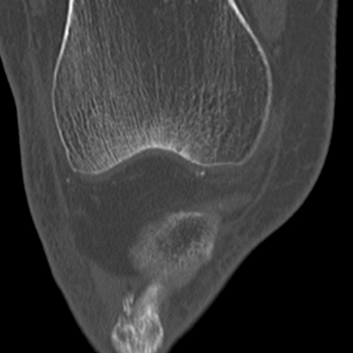 Chondrocalcinosis (Radiopaedia 16275-15955 Coronal bone window 20).jpg