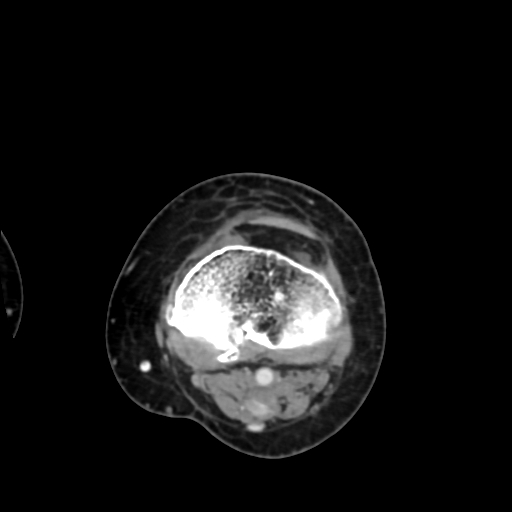 Chondrosarcoma - femur (Radiopaedia 64187-72954 Axial with contrast 61).jpg