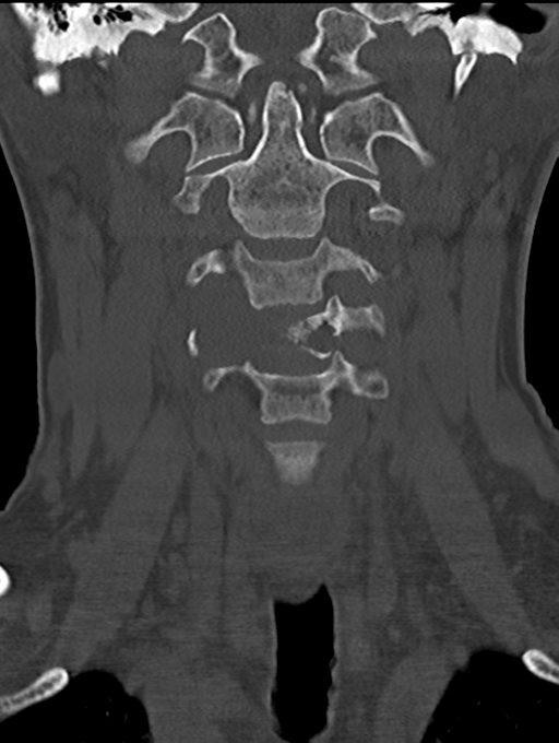 Chordoma (C4 vertebra) (Radiopaedia 47561-52188 Coronal bone window 15).png