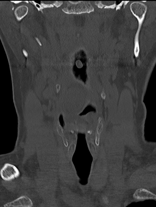 Chordoma (C4 vertebra) (Radiopaedia 47561-52188 Coronal bone window 7).png