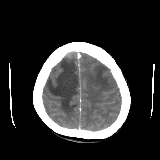 File:Choriocarcinoma of ovary with cerebral and pulmonary metastases (Radiopaedia 25983-26118 A 21).jpg