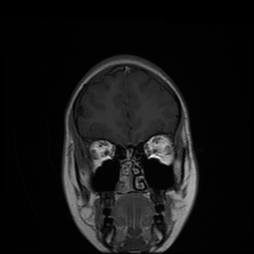 File:Choroid plexitis - tuberculous meningitis (Radiopaedia 26344-26484 Coronal T1 C+ 1).jpg