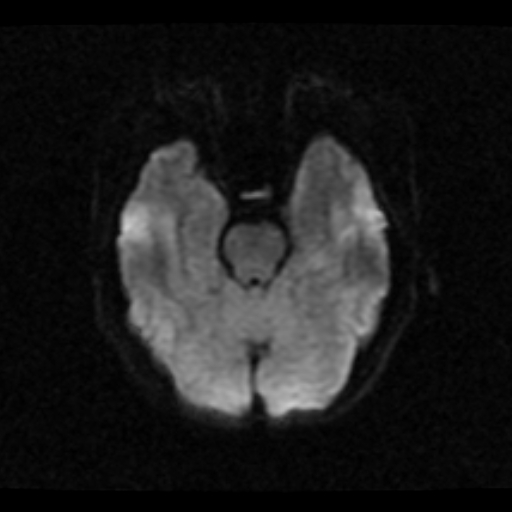 File:Choroid plexus xanthogranuloma (Radiopaedia 17650-17386 DWI 16).jpg
