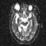 File:Choroid plexus xanthogranuloma - unilateral (Radiopaedia 85632-101393 Axial ADC 27).jpg