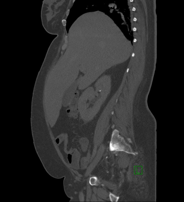Chromophobe renal cell carcinoma (Radiopaedia 84239-99519 Sagittal bone window 72).jpg