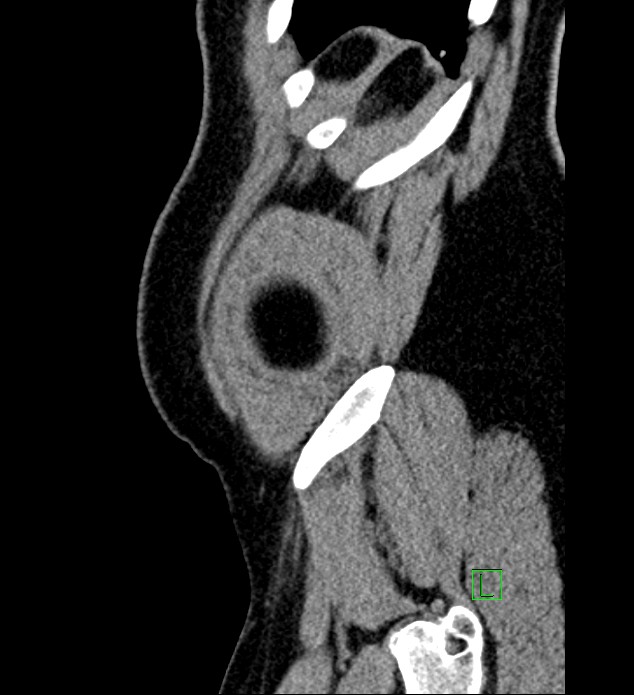 Chromophobe renal cell carcinoma (Radiopaedia 84286-99573 C 1).jpg
